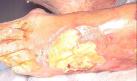 Image of sloughy wound.
