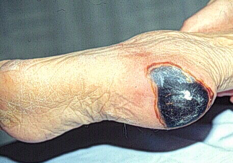 Necrotic Wound