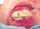 Picture of a granulating wound.