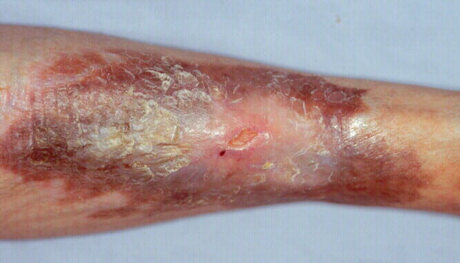 # Diabetic Ulcers On Legs - Pre Diabetes Blood Sugar Level