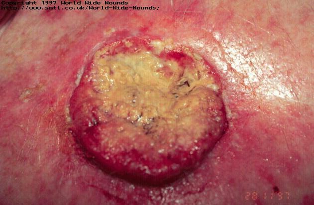 The use of sterile larvae (maggots) in a malignant wound.