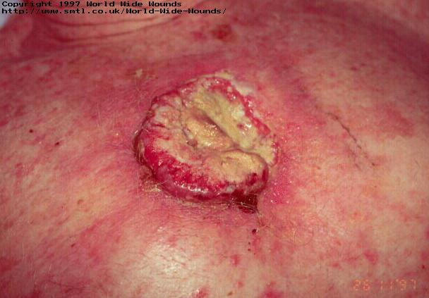 The use of sterile larvae (maggots) in a malignant wound.