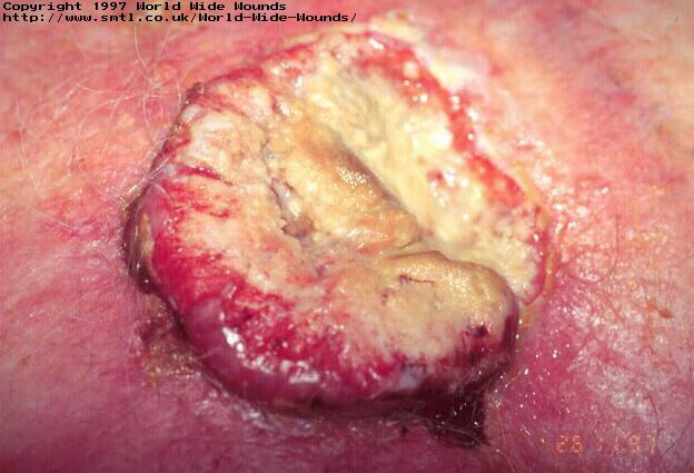 The use of sterile larvae (maggots) in a malignant wound.