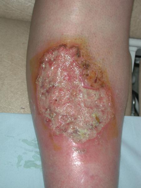 Wound Care of the Legs | SSM Vascular Institute