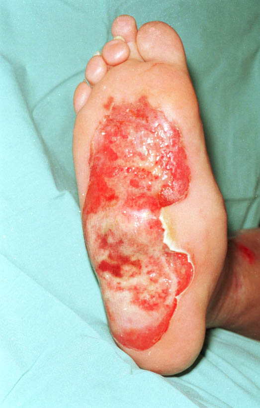 Figure 1 - Full thickness burn to sole of right foot two days after 