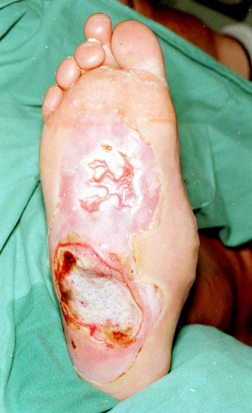 Case report: maggot therapy in an acute burn