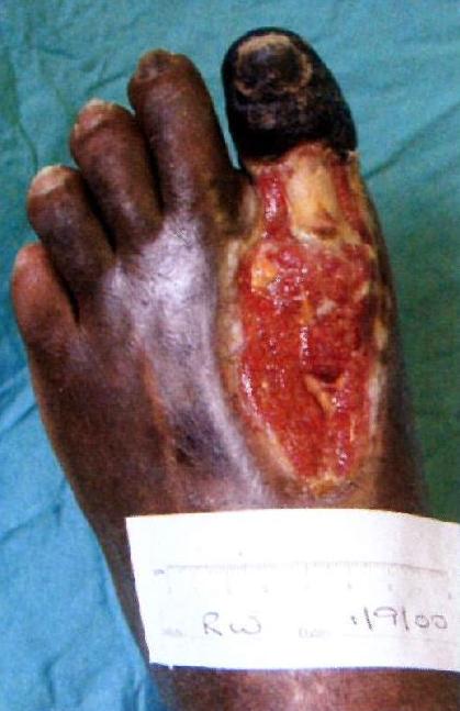 Management of a diabetic foot ulcer using larval therapy