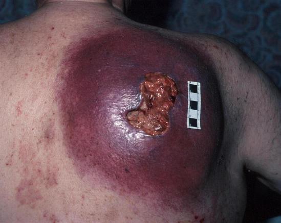 Fig-1-Melanoma-Back.jpg