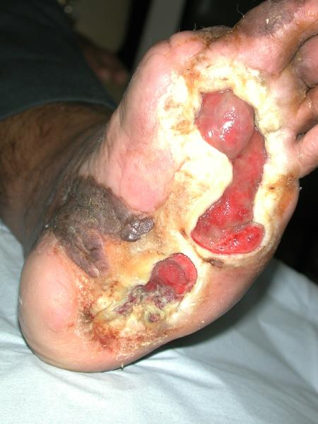 Diabetes, Foot Care and Foot Ulcers. Diabetic foot disease ...