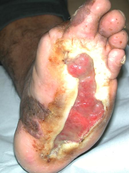 sores on feet