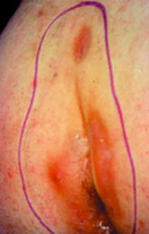 http://www.worldwidewounds.com/2003/december/Miller/images/pilonidal-no-1.jpg