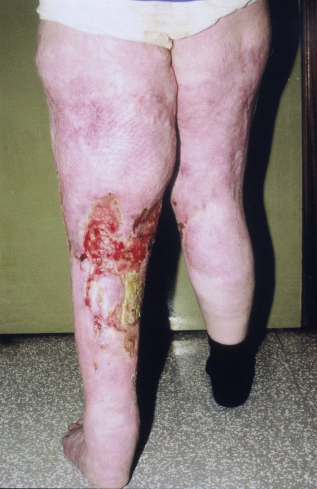 Venous ulcer - Wikipedia