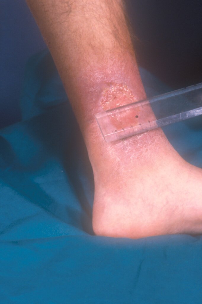 Treatment. A conventional treatment regimen for pyoderma gangrenosum 