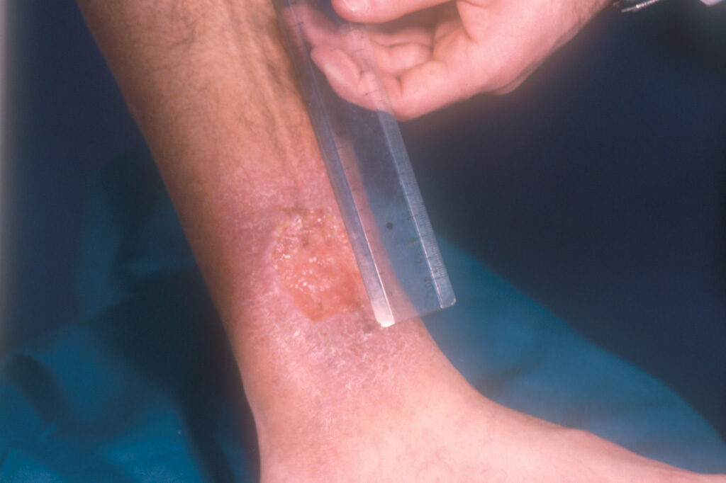 Treatment. A conventional treatment regimen for pyoderma gangrenosum 