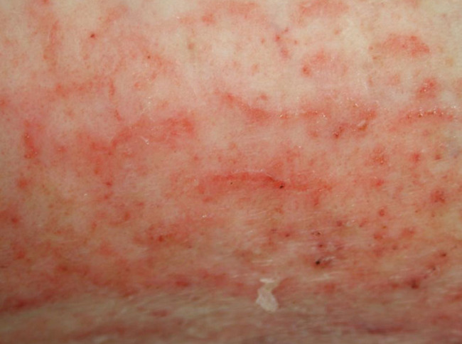 Bacterial infections and atopic dermatitis - Breuer - 2008 ...